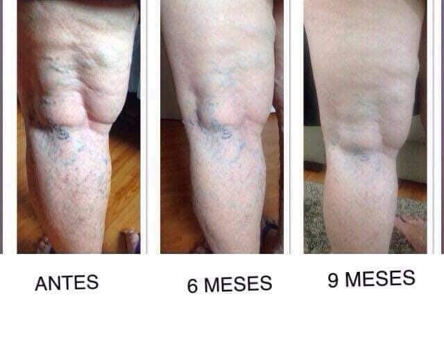 Várices antes y después