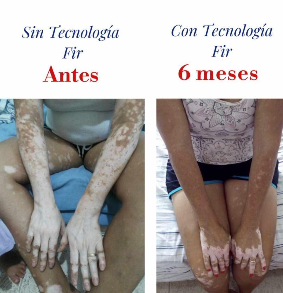 Vitíligo antes y después
